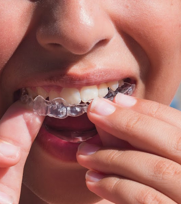 How does Invisalign® First treatment work?