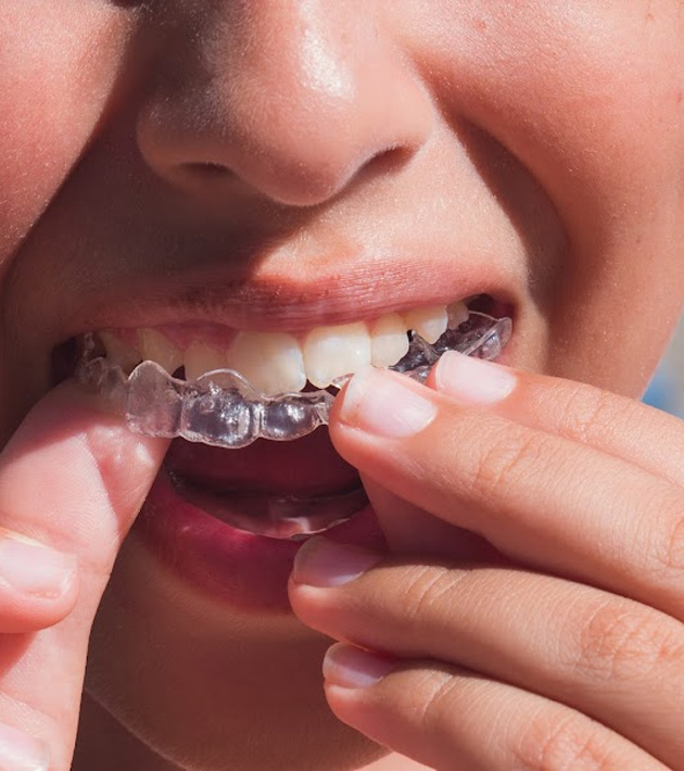 6 Reasons to Consider Invisalign First for Your Child