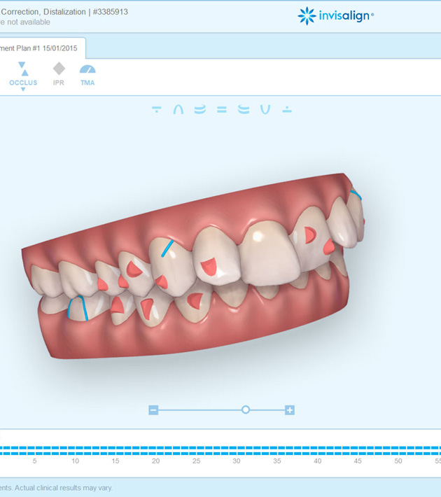 See into the future with ClinCheck® software